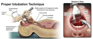 smart phone Laryngoscope