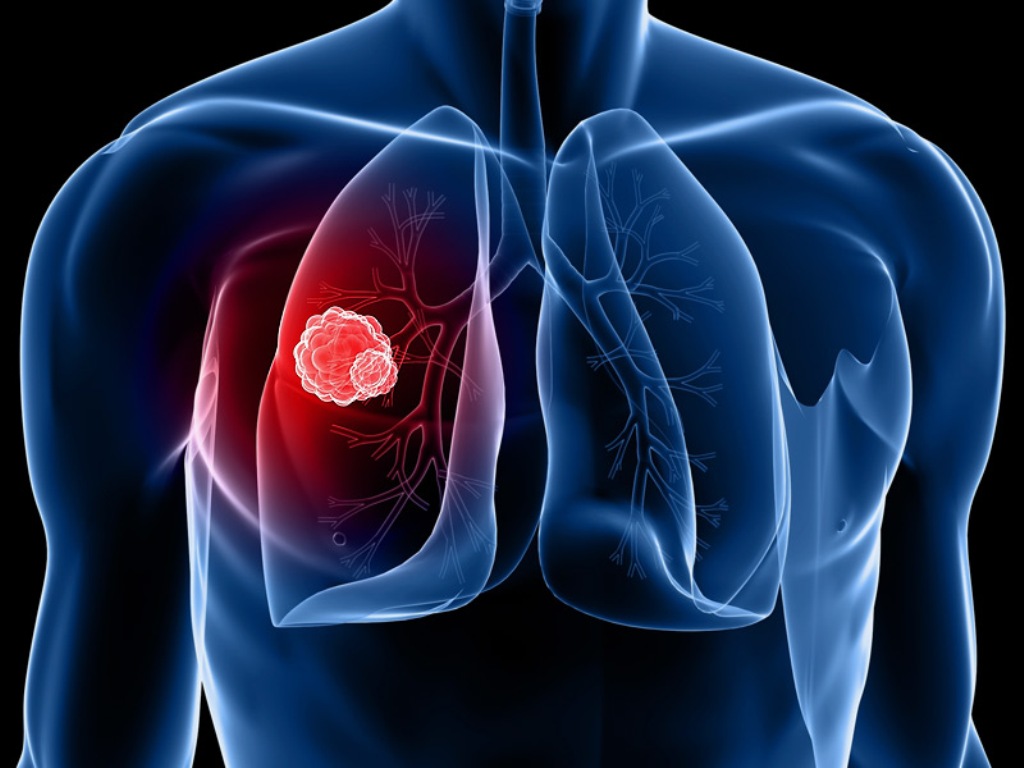 Surroundings can also be the reason for lung cancer