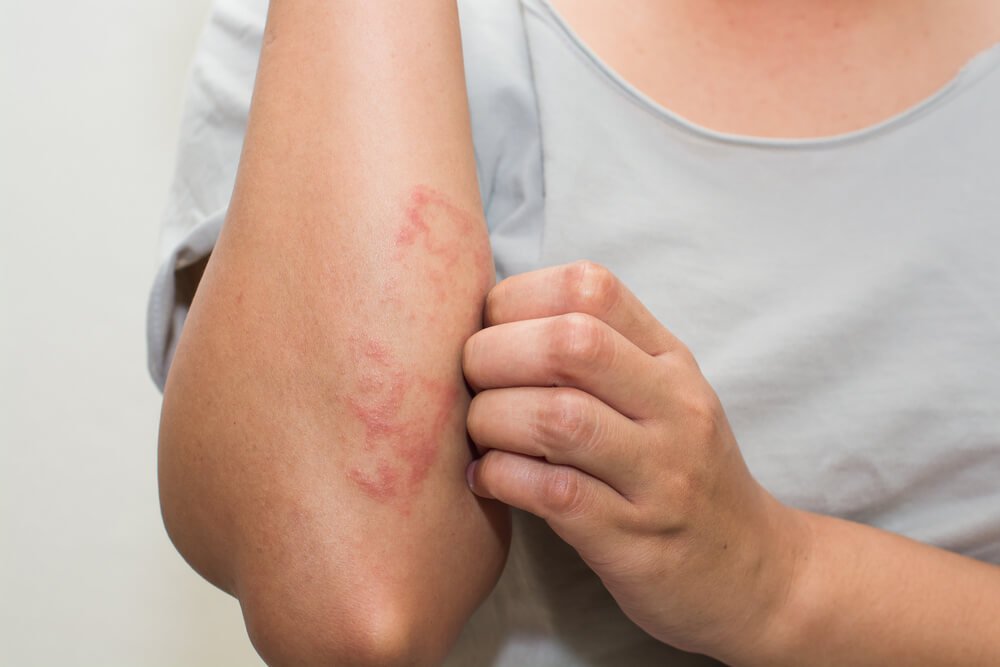 these home remedies will end rashes and skin problem