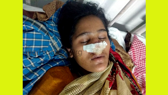 Shahjahanpur Tilhar: Husband cuts off wife's nose In minor dispute